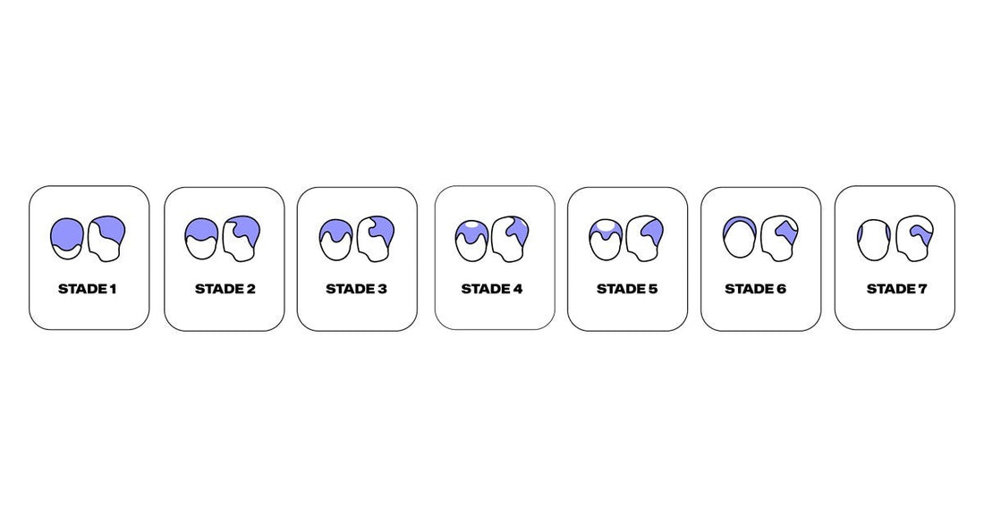 Hairdex avis : une SAS marseillaise qui publie tout de son identité, un hébergement certifié données de santé, et du finastéride au bout du questionnaire